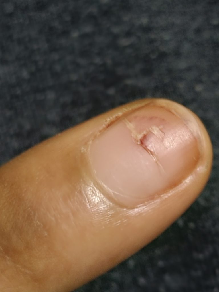 Photo of punctured finger wound by needle 